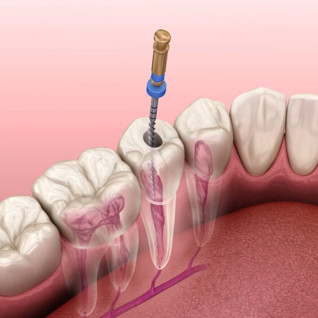 Single Sitting Rct pearldentalcare